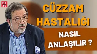 Cüzzam hastalığı nedir, nasıl tedavi edilir?