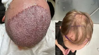 hair transplant in Bellus clinic in Istanbul