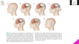 Surgical Indications of Ischemic Strokes