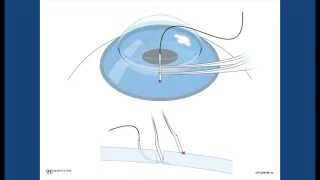 Corneal Suturing, Part 3 - Engaging the Needle Deep in the Host