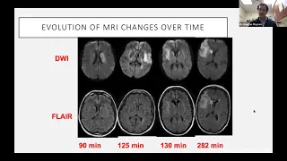 Management of Acute Stroke