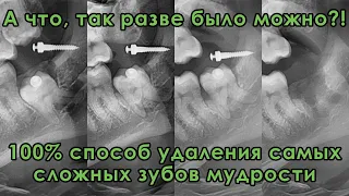 Полный кейс: вытяжение сложного зуба мудрости из челюсти, как избежать онемения губы и подбородка?