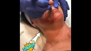 Microneedling & Chemical Peel!!