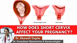 How does Short Cervix affect your pregnancy ? Causes, Diagnosis & Treatment | Healing Hospital
