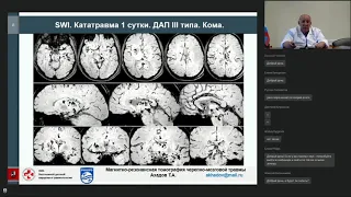 Магнитный резонанс в научно-клинической практике исследований черепно-мозговой травмы
