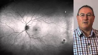 Peripheral Retinal Degenerations (2013) - Simon Browning B.Sc. (Hons) MCOptom