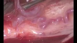 Surgical occlusion of a spinal dural arteriovenous fistula