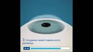 Lasik Custom Vue — индивидуализированная лазерная коррекция