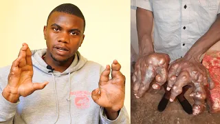 The Man With Giant 'Claw' Hands Shocked Everyone | BORN DIFFERENT