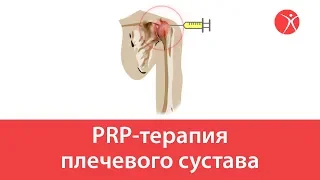 PRP-терапия плечевого сустава