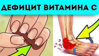 Сигналы организма о нехватке витамина С