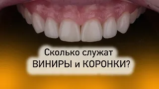 Сколько служат виниры и коронки на зубах?