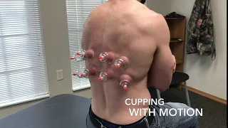 Cupping With Motion Therapy: Increase Crossfit Mobility