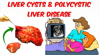 Liver Cysts And Polycystic Liver Disease
