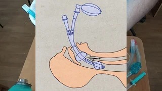 КОМБИТЬЮБ (COMBITUBE) ТРАХЕО-ПИЩЕВОДНАЯ ТРУБКА  АБАКАН  ТЕХНИКА УСТАНОВКИ ВВЕДЕНИЯ