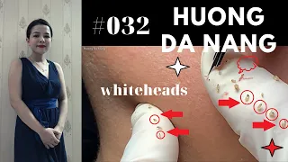 #032 | Hidden acne and whiteheads | Mụn ẩn và mụn đầu trắng | Hương Đà Nẵng