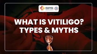 What is Vitiligo? Types and Myths | SPS Hospitals