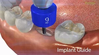 Dentium Implant Guide