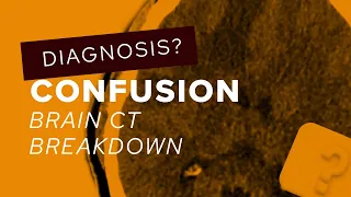 CT Head breakdown: how to identify and deal with multiple space occupying lesions