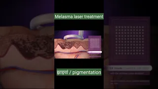 Melasma /झाइयां laser treatment || Treatment for pigmentatio || How it works ?
