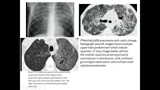 TB and endemic fungi