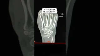 CT Wrist Joint #viral #wristjoint #ct #shortsfeed