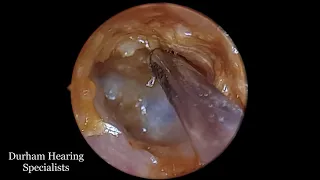 Earwax soup created by sodium bicarb drops suctioned off eardrum