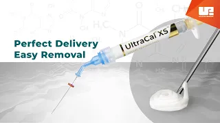 UltraCal™ XS Overview | Delivery and Removal