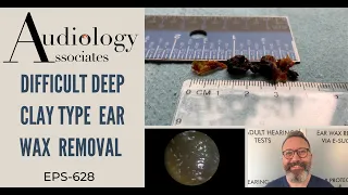 DIFFICULT DEEP CLAY TYPE EARWAX REMOVAL - EP628