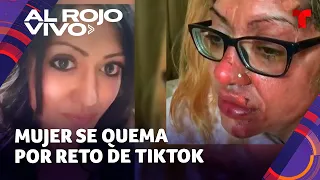 Mujer sufre quemaduras en su rostro tras realizar un reto de TikTok