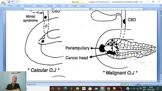 Biliary  disorders in Arabic 15  ( Obstructive jaundice , part 3 ) , by Dr. Wahdan