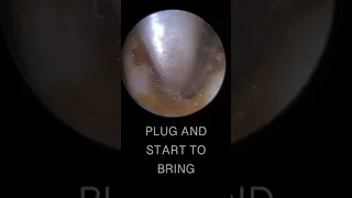 SUPER STICKY DEEP EAR WAX REMOVAL