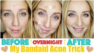 How to Get Rid of Acne Fast & OVERNIGHT with My Bandaid Trick!
