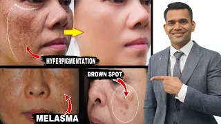 Get Rid Of Hyperpigmentation, Melasma, Brown Spot Naturally - Dr. Vivek Joshi