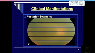 Intermediate Uveitis