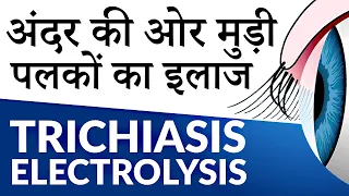 Ingrown/Misdirected Eyelashes (Trichiasis) | अंदर की ओर मुड़ी पलकें (ट्राइकियासिस) का इलाज