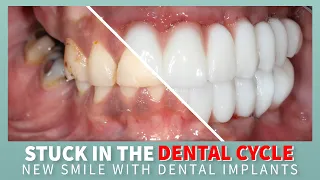 Wanted a new smile fast!!! How to get the best dental implant smile in one day!