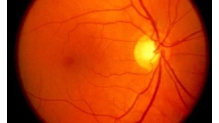 Retinal Consultants of Arizona Presents - Macular Hole Surgery Patient Education