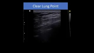 A Very clear lung point