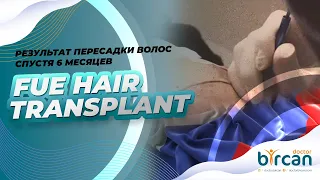 РЕЗУЛЬТАТ ПЕРЕСАДКИ ВОЛОС СПУСТЯ 6 МЕСЯЦЕВ l FUE HAIR TRANSPLANT RESULTS AFTER 6 MONTHS