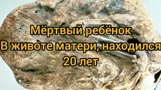 Тело мёртвого младенца находилось 15 лет в животе женщины (ОСТОРОЖНО! НЕ ДЛЯ СЛАБОНЕРВНЫХ)