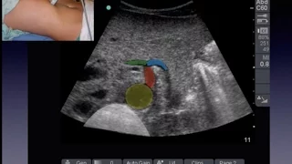 Aorta Ultrasound