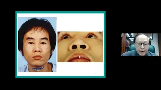 Feb. 20th. 2022 The International Craniofacial Chang Gung Webinar