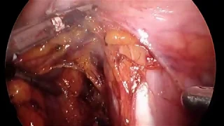 unedited full laparoscopic Pelvic nerve mapping and dissection made easy