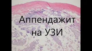 Состоявшийся аппендажит - случай УЗИ диагностики состоявшегося аппендажита