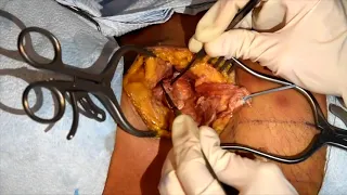 Proximal Rectus Femoris Avulsion Repair