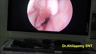 Orbital Subperiosteal Abscess - Endoscopic Orbital decompression