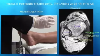 Webinar: Ultrasound for the Foot and Ankle Part 2