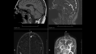 Cortical Vein thrombosis and Dural Veinou Sinus thrombosis can be missed on CT. MR is helpful