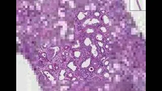 Histopathology Kidney--Rapidly progressive glomerulonephriti